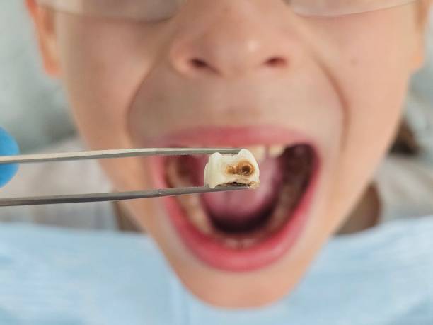 Best Emergency Root Canal Treatment in Mcleansville, NC