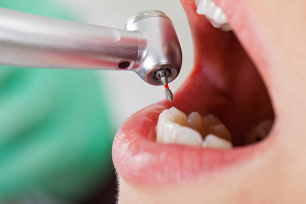 Best Emergency Dental Care for Abscessed Tooth in Mcleansville, NC